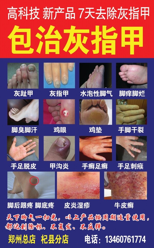 灰指甲