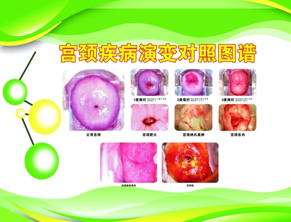 宮頸疾病對照表圖片