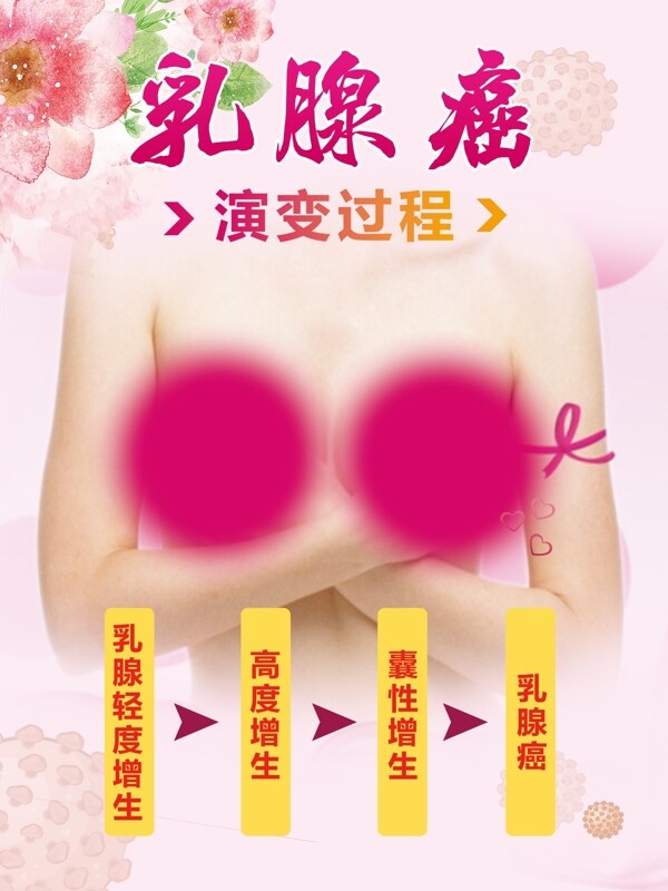 乳腺癌演变过程