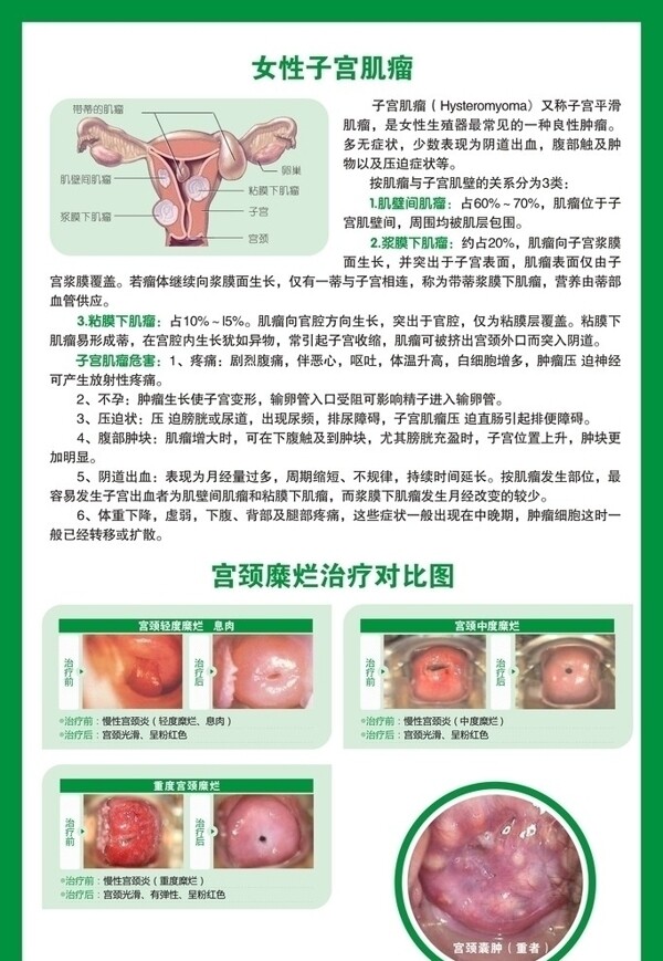 子宫肌瘤和宫糜广告图片