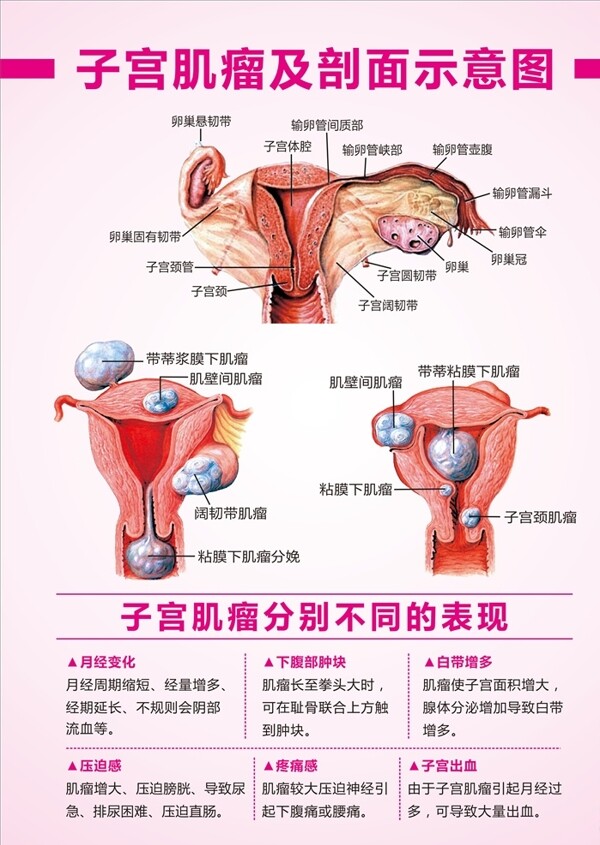 子宫肌瘤示意图子宫肌瘤表现