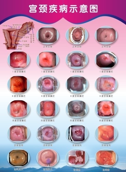 宫颈疾病示意图图片
